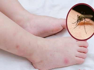 Cách trị vết thâm muỗi đốt lâu ngày cho bé 