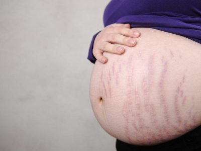 Bụng rạn sau sinh: Nguyên nhân và cách khắc phục đơn giản tại nhà