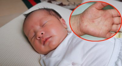 Chăm sóc trẻ bị tay chân miệng tại nhà để tránh biến chứng