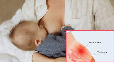 Dấu hiệu tắc tia sữa: Mẹ lưu ý không nên bỏ lỡ!