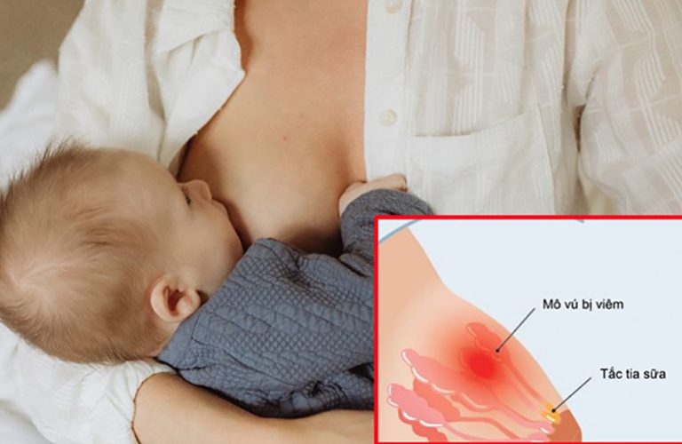 Mẹ bị tắc tia sữa sau sinh đang cho con bú