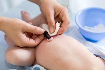 Nhiễm trùng rốn ở trẻ sơ sinh: Mối lo ngại mẹ không thể phớt lờ!