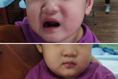 Bé 24 tháng tuổi liệt mặt vì thói quen ít để ý của bố mẹ khi đi xe máy
