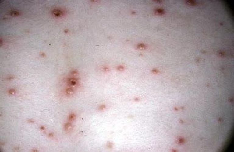 Dấu hiệu nhận biết của bệnh Thủy đậu