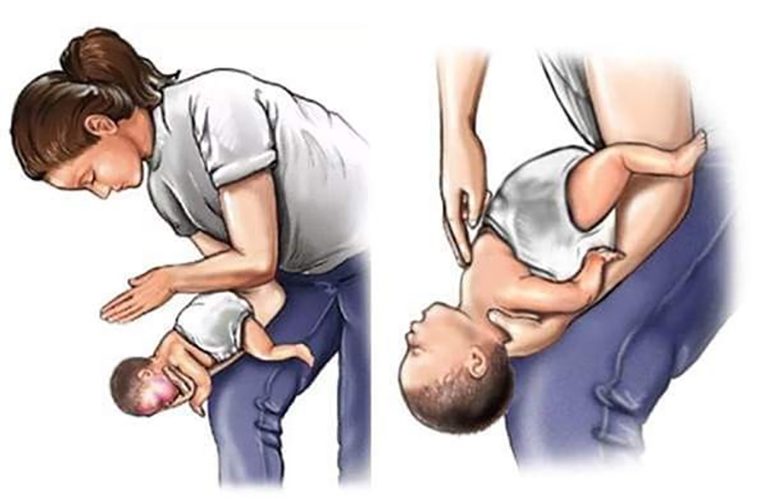 Tiến hành động tác sơ cứu khi trẻ hóc dị vật.