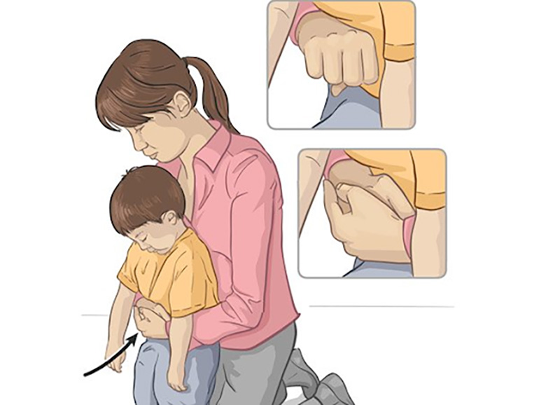 Sơ cứu trẻ bị hóc dị vật bằng phương pháp Heimlich