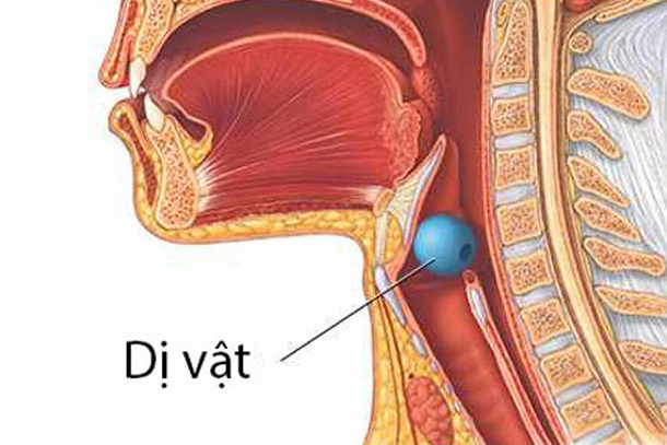 Hóc dị vật