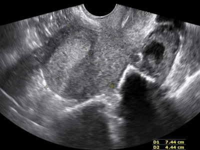 Ngôi Thai Ngang Là Gì? Nguyên Nhân Và Dấu Hiệu Nhận Biết