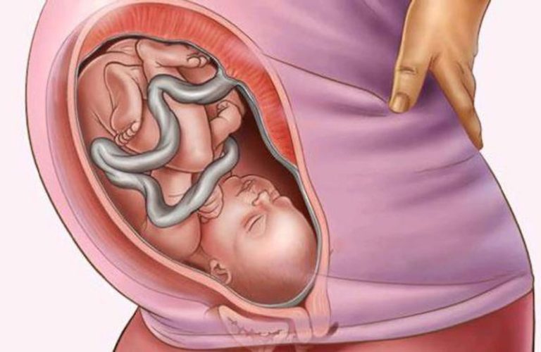 Dây rốn quấn cổ thai nhi