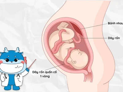 Dây Rốn Quấn Cổ 1 Vòng: Giải Đáp Thắc Mắc