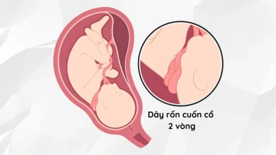 Dây Rốn Quấn Cổ 2 Vòng: Góc Nhìn Chuyên Sâu