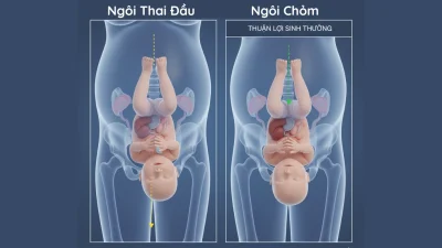 Cùng Mẹ Tìm Hiểu Ngôi Thuận và Ngôi Thai Đầu Là Gì